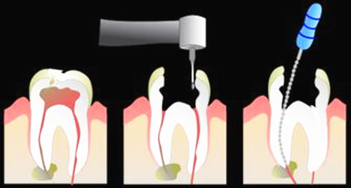惊!根尖周病竟有这么大危害!中老年人成“重灾人群”!