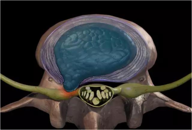 如此严重的腰椎间盘突出症，没开刀，但是治好了