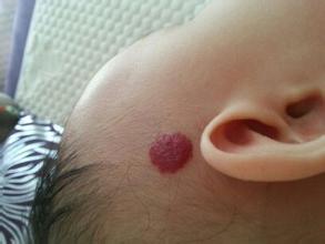 血管瘤和红斑区别,红色小斑是血管瘤吗