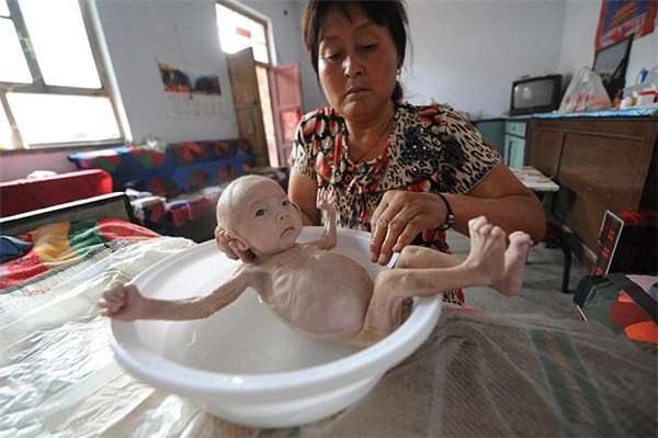 男婴先天无肛怎么排便,出生无法排便的罕见病宝宝