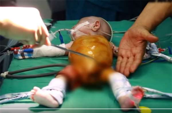 男婴先天无肛怎么排便,出生无法排便的罕见病宝宝