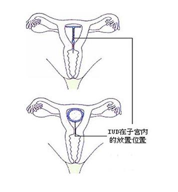上环是避孕最好的方法吗？对身体会造成什么危害呢？