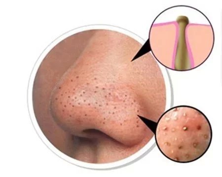 去黑头小妙招超简单,去黑头小妙招简单有效