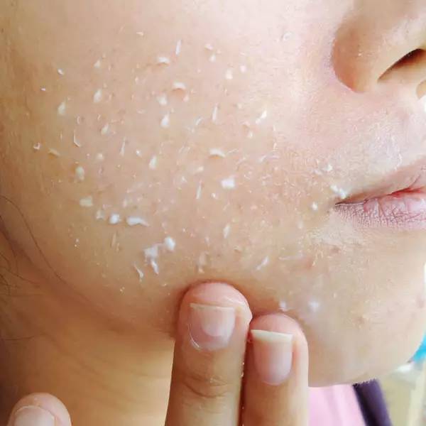 脸上有红色痘印而且脱皮,脸上的红色痘印怎么消除