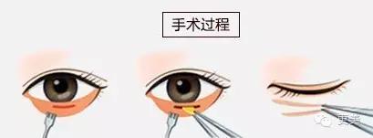 脸部自体脂肪填充术后多久消肿,自体脂肪填充术后多久有效果