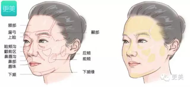 脸部自体脂肪填充术后多久消肿,自体脂肪填充术后多久有效果