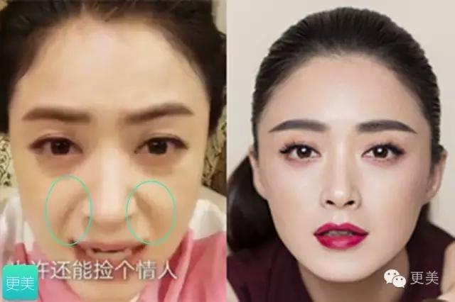 脸部自体脂肪填充术后多久消肿,自体脂肪填充术后多久有效果