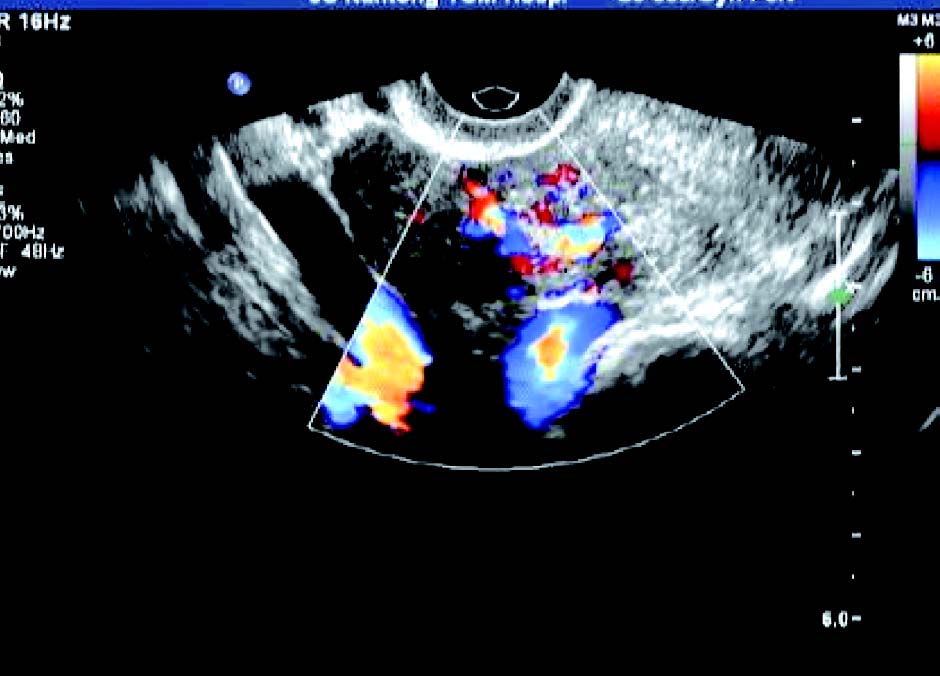 子宫圆韧带肌瘤的超声表现,子宫肌壁间肌瘤超声影像