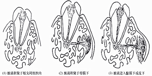 惊!根尖周病竟有这么大危害!中老年人成“重灾人群”!