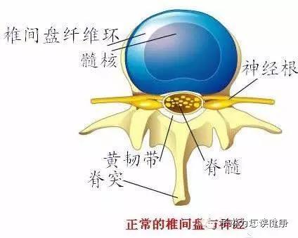 如此严重的腰椎间盘突出症，没开刀，但是治好了