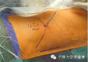 如此严重的腰椎间盘突出症，没开刀，但是治好了