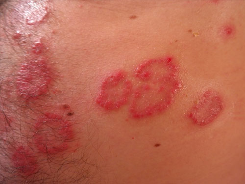 湿疹的克星一招搞定,难缠的湿疹如何击退