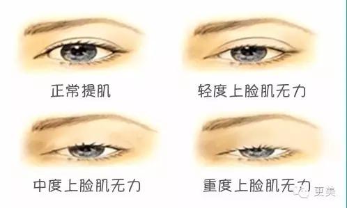 脸部自体脂肪填充术后多久消肿,自体脂肪填充术后多久有效果