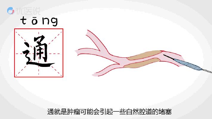 肿瘤治疗的“新*器武**”——介入治疗