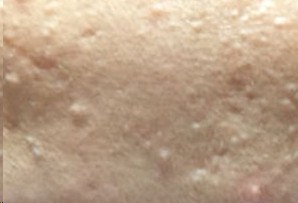 脸上长闭合性粉刺和痤疮怎么办,脸上闭合性粉刺怎么去除最有效