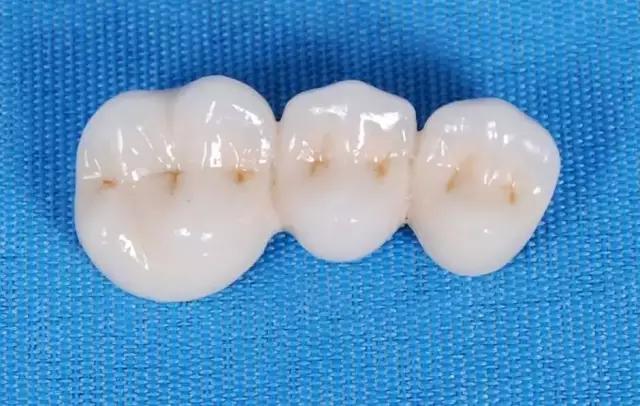 牙医为什么建议做二氧化锆,被牙医骗了的二氧化锆