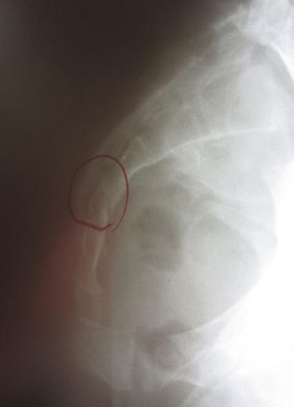 脊柱棘突疼痛,脊柱尾骨疼痛怎么回事