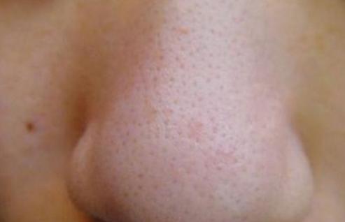 黑头鼻贴的正确贴法图,rnw黑头贴正确用法