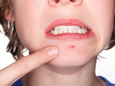 为何痘痘君对你不离不弃？