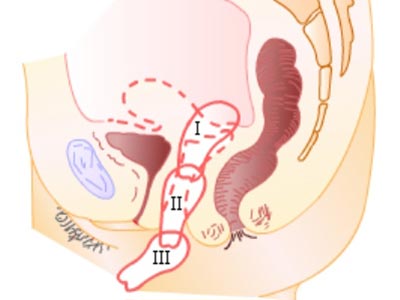 子宫脱垂对老年女性有哪些危害?