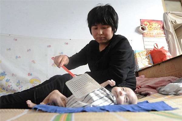 男婴先天无肛怎么排便,出生无法排便的罕见病宝宝