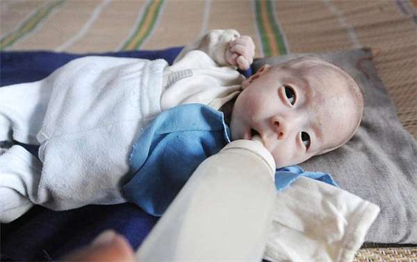 男婴先天无肛怎么排便,出生无法排便的罕见病宝宝