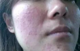 脸上长红色凸起小疙瘩,儿童脸上长小米粒疙瘩