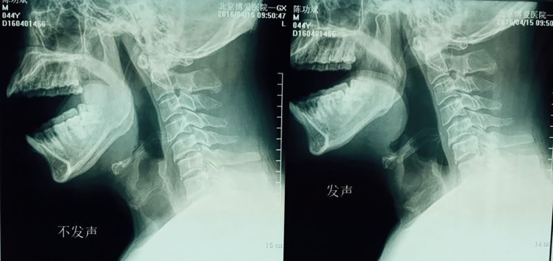 成人功能性构音障碍矫正,构音障碍康复治疗得多久