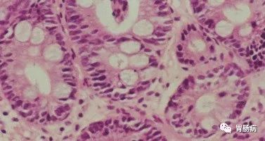 肠化是肠道出毛病了吗,胃萎缩肠化就是癌变的前兆吗