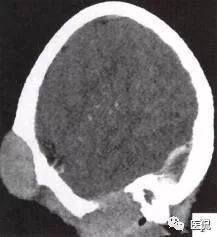 3岁小孩头上有个包做ct说是骨瘤,小孩头部ct为什么会增加肿瘤几率