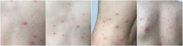 「水痘」都说出水痘不能吹风，真的吗？假的！