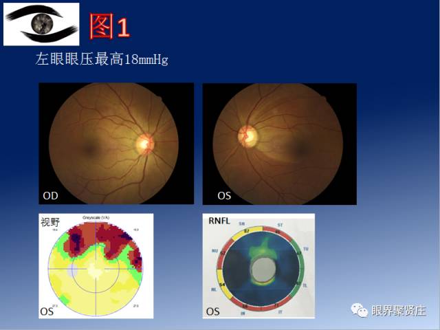 二十种眼型图解阴阳眼,青光眼能做九宫格眼底照相吗