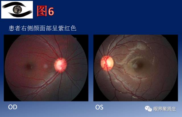 二十种眼型图解阴阳眼,青光眼能做九宫格眼底照相吗