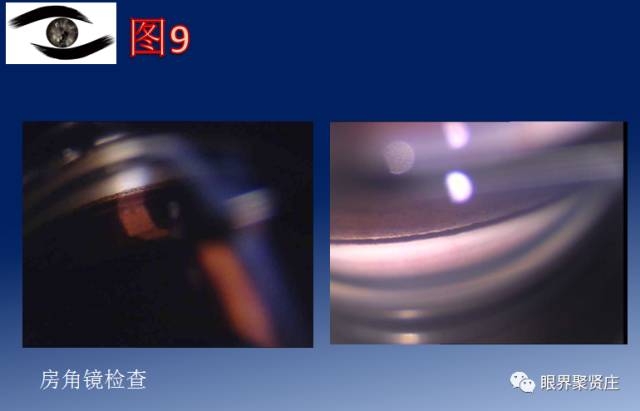 二十种眼型图解阴阳眼,青光眼能做九宫格眼底照相吗