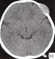 3岁小孩头上有个包做ct说是骨瘤,小孩头部ct为什么会增加肿瘤几率