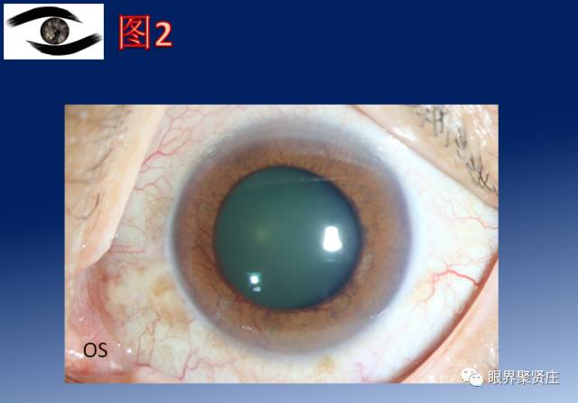 二十种眼型图解阴阳眼,青光眼能做九宫格眼底照相吗