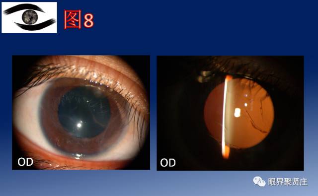 二十种眼型图解阴阳眼,青光眼能做九宫格眼底照相吗