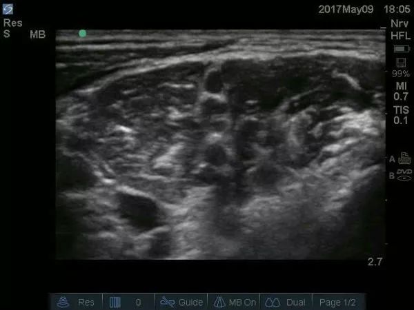 超声引导隐神经阻滞视频教学,超声引导下腰椎旁神经阻滞视频