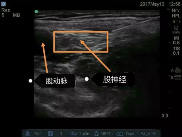 超声引导隐神经阻滞视频教学,超声引导下腰椎旁神经阻滞视频