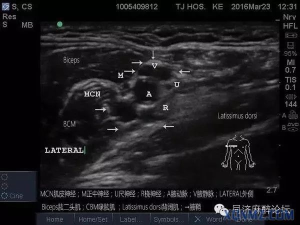 超声引导隐神经阻滞视频教学,超声引导下腰椎旁神经阻滞视频
