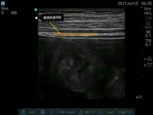 超声引导隐神经阻滞视频教学,超声引导下腰椎旁神经阻滞视频