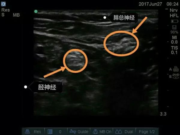 超声引导隐神经阻滞视频教学,超声引导下腰椎旁神经阻滞视频