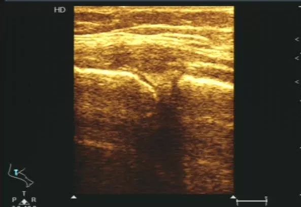 超声提示不发育了怎么回事呢,超声检查不硬咋办
