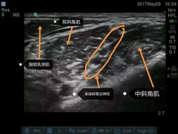 超声引导隐神经阻滞视频教学,超声引导下腰椎旁神经阻滞视频