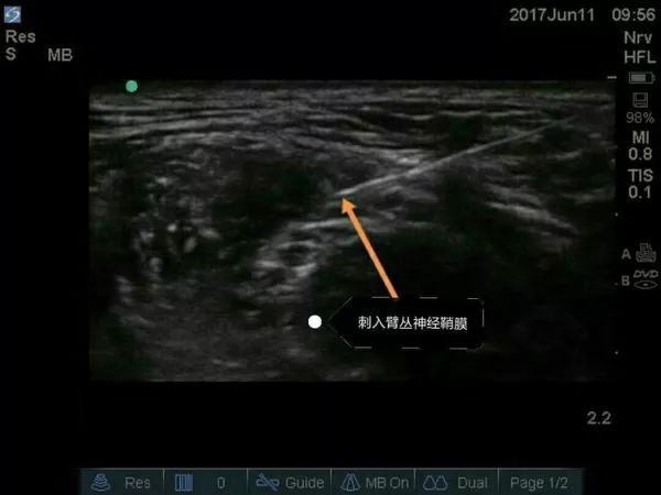 超声引导隐神经阻滞视频教学,超声引导下腰椎旁神经阻滞视频