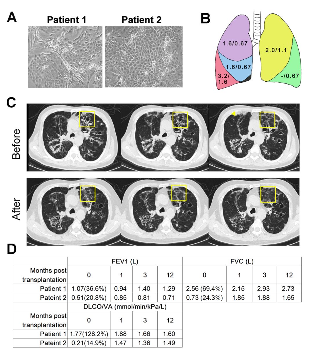 人类干细胞重造动物器官,人类首次肺脏再生是哪一年