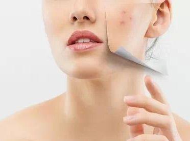 如何祛痘淡化痘印最有效的方法,怎样有效祛痘印