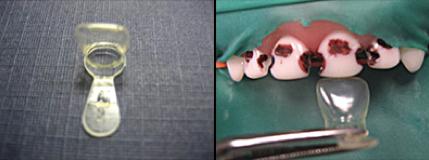 前牙光固化美容修复的方法,乳前牙预成冠修复过程