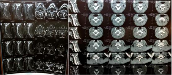 颈椎病头部憋胀怎么办,病人喉咙呼噜呼噜有痰怎么办