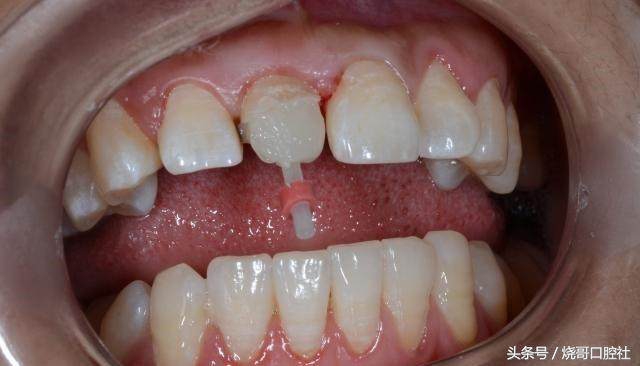 门牙磕掉一丢丢可以长回去吗,2岁宝宝门牙磕掉了一角怎么补